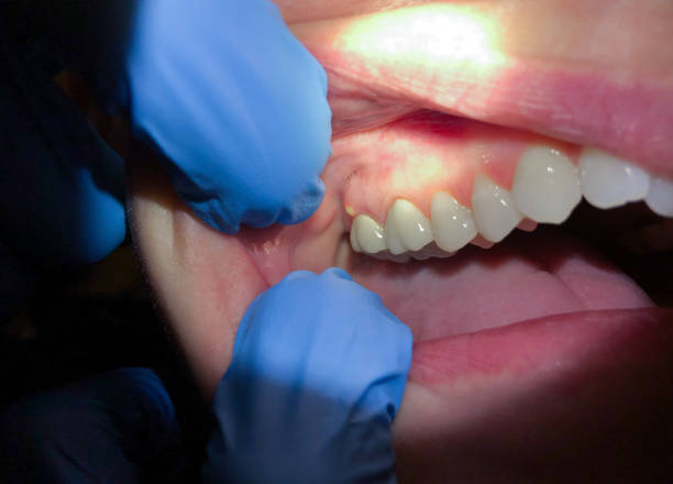 Urgent Tooth Repair in NJ